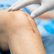 knee replacement last