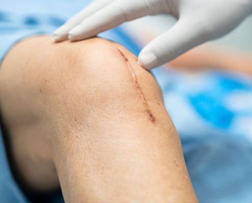 knee replacement last