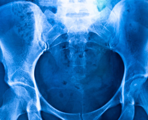 Hip pain with normal x-ray