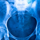 Hip pain with normal x-ray