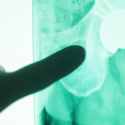 Periprosthetic Joint Infection