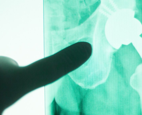 Periprosthetic Joint Infection